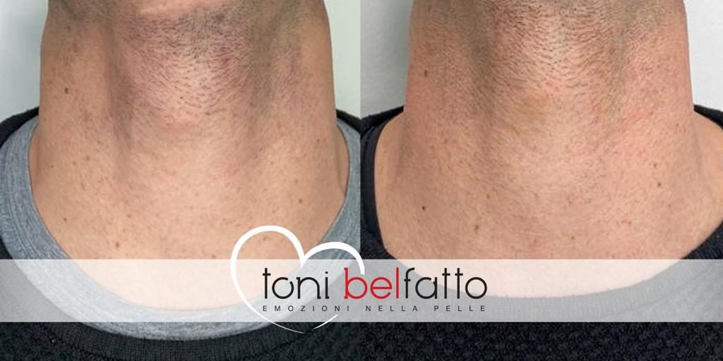 Dopo: ricostruzione cromatica della barba con tricopigmentazione