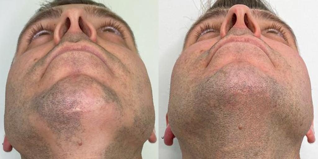 Prima: alopecia areata della barba