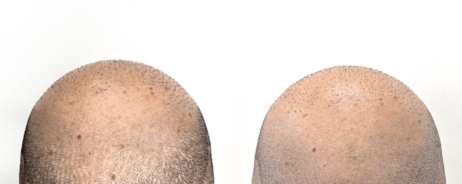 Prima: alopecia con scopertura del cuoio capelluto