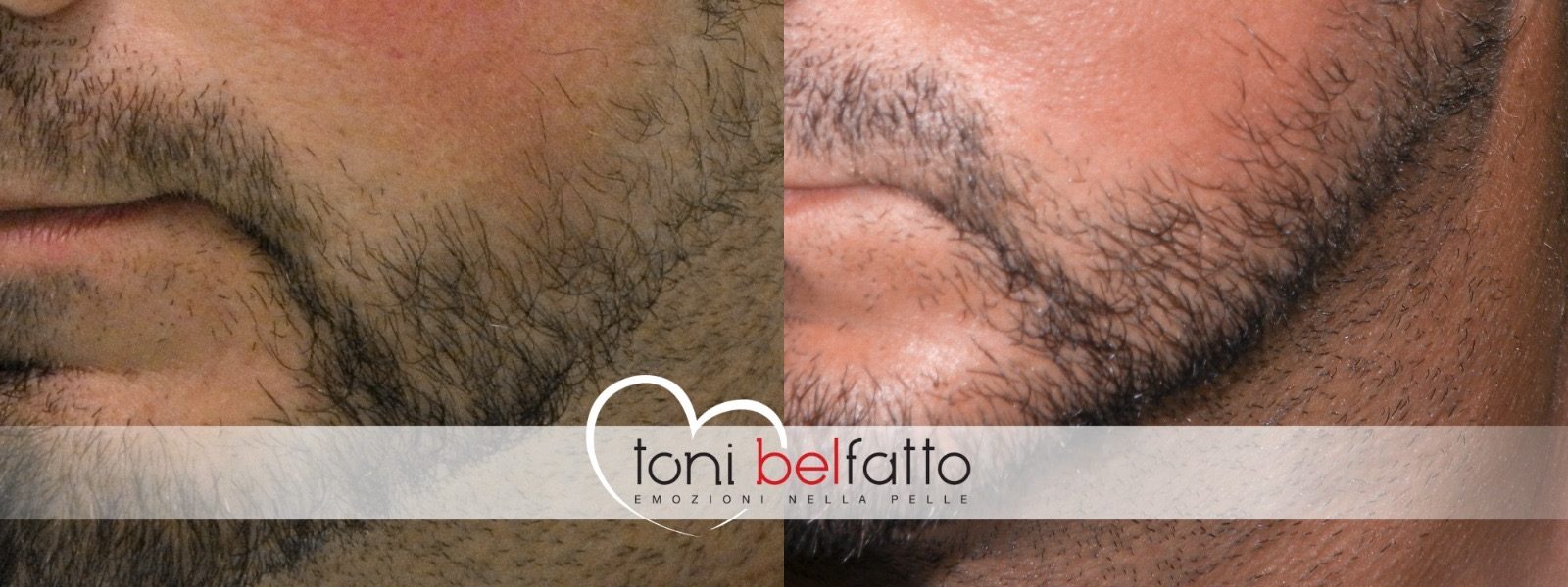 Dopo: copertura camouflage di esiti vascolari del volto